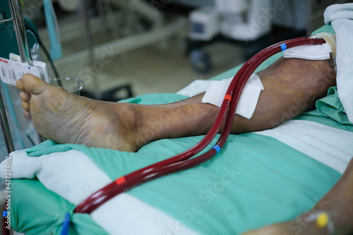 Konstfotografi patient's leg with extracorporeal membrane oxygenation line (ECMO) on bed at cri
