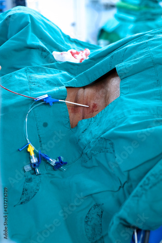 anesthetist setting central venous catheter to patient before open heart surgery