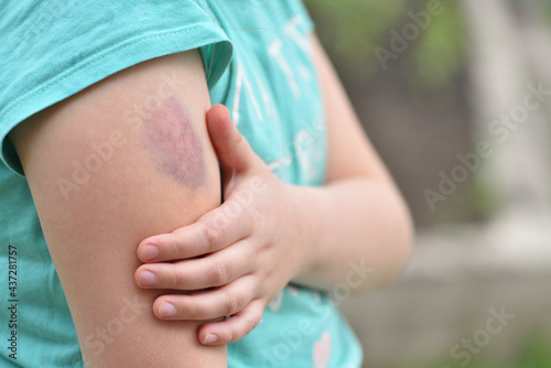 The child is holding on to a large bruise on his arm