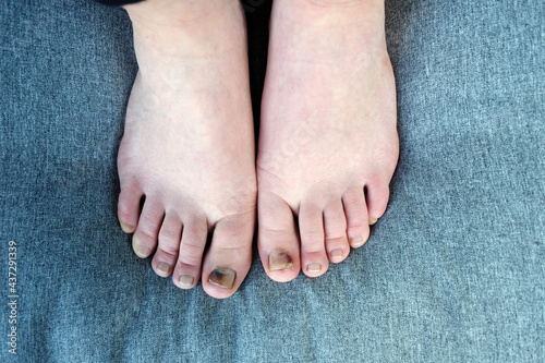 female feet with 'subungual hematoma', black toenails caused by trauma after watking 30 miles.
 photo