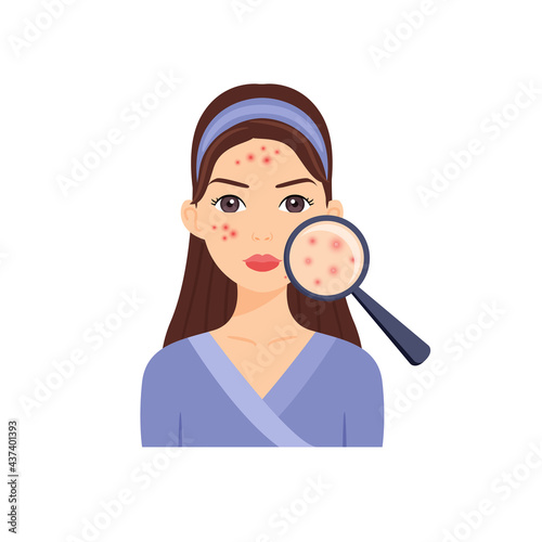 Beautiful Brunette Woman with Problem Skin. Magnifying Glass and Pimples. A Girl with a Head Band, Clothes, Pimples.