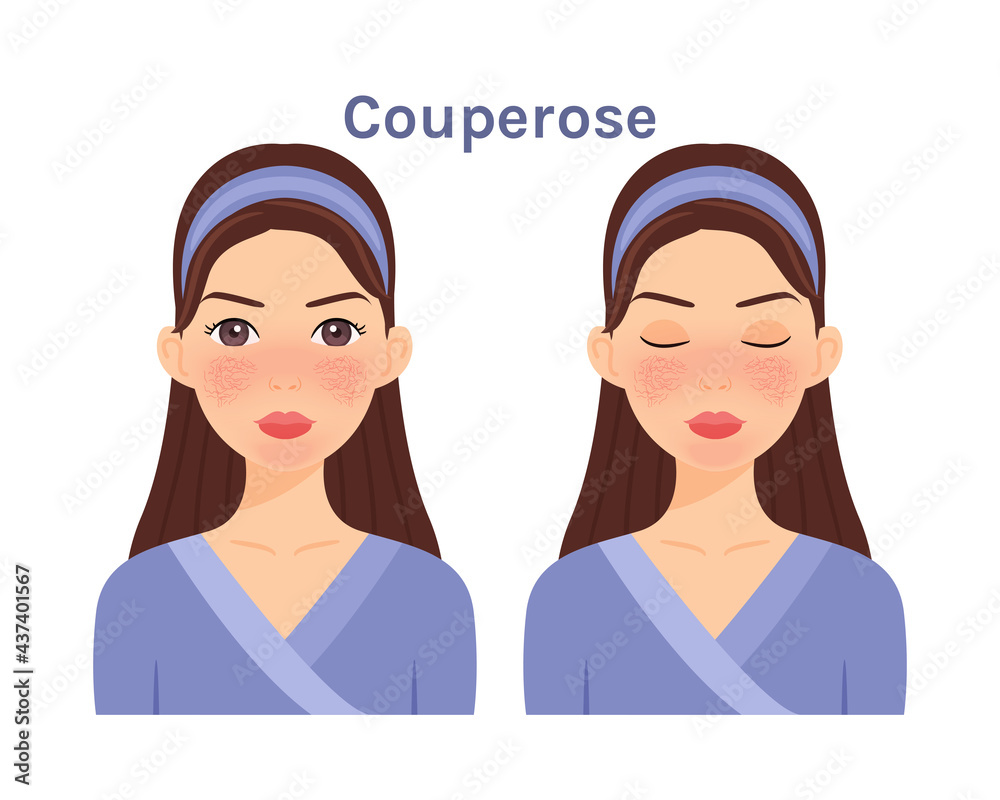 Couperose. Isolated Beautiful Brunette woman. Cute face. Skin disease.Treatment.Woman with open eyes and closed. White background. Color Flat cartoon illustration.Poster.Vector stock illustration. Couperose. Isolated Beautiful Brunette woman. Cute face. Skin disease.Treatment.Woman with open eyes and closed. White background. Color Flat cartoon illustration.Poster.Vector stock illustration.
