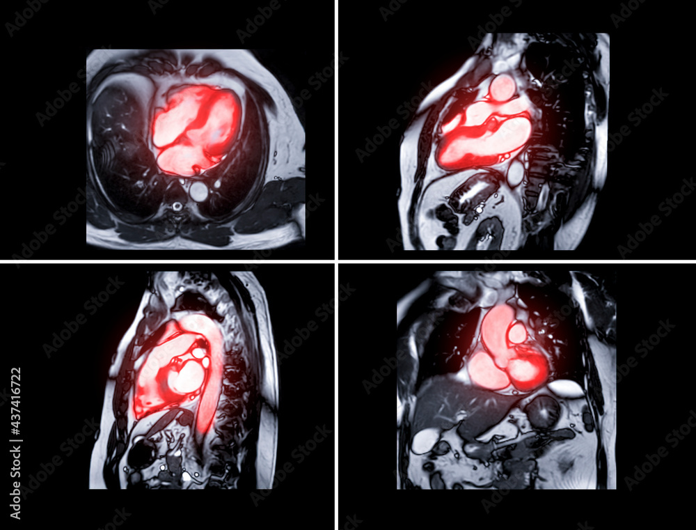 Collection of MRI heart or Cardiac MRI resonance imaging of
