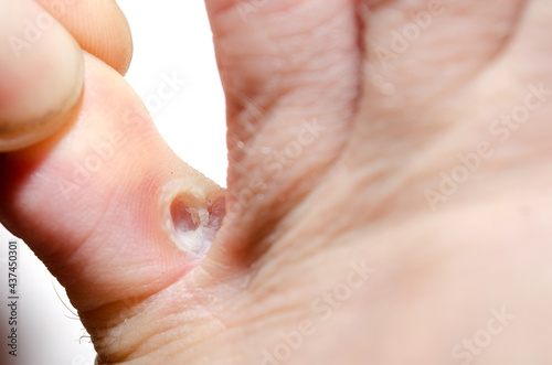 Fungal infection between the toes of the adult man close up photo