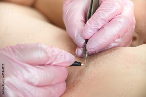 Electrologist remove hair in a woman s armpits using metod electro epilation in pink gloves. Close up.