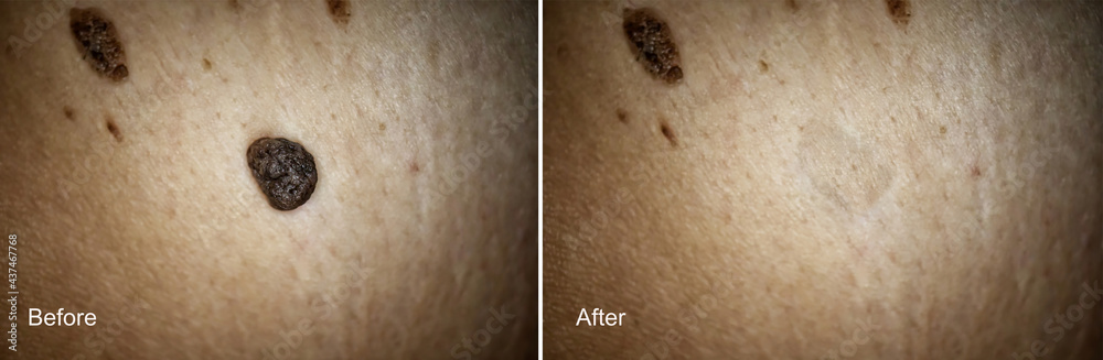Photo Before and After removal of Large Mole on woman skin. Mole removal concept. Selective focus Photo Before and After removal of Large Mole on woman skin. Mole removal concept. Selective focus