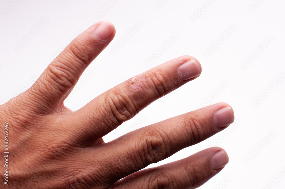 finger of hand with plaque scleroderma morphea, extended fingers StockFoto Adobe Stock