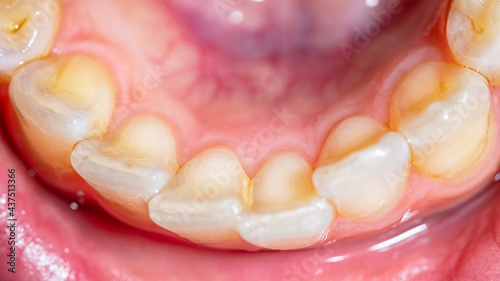 Lower dental arch full of plaque. Layer of bacterial plaque around the dental collar close to the gumline. Concept poor oral hygiene, teeth cleaning and risk of infections and caries.