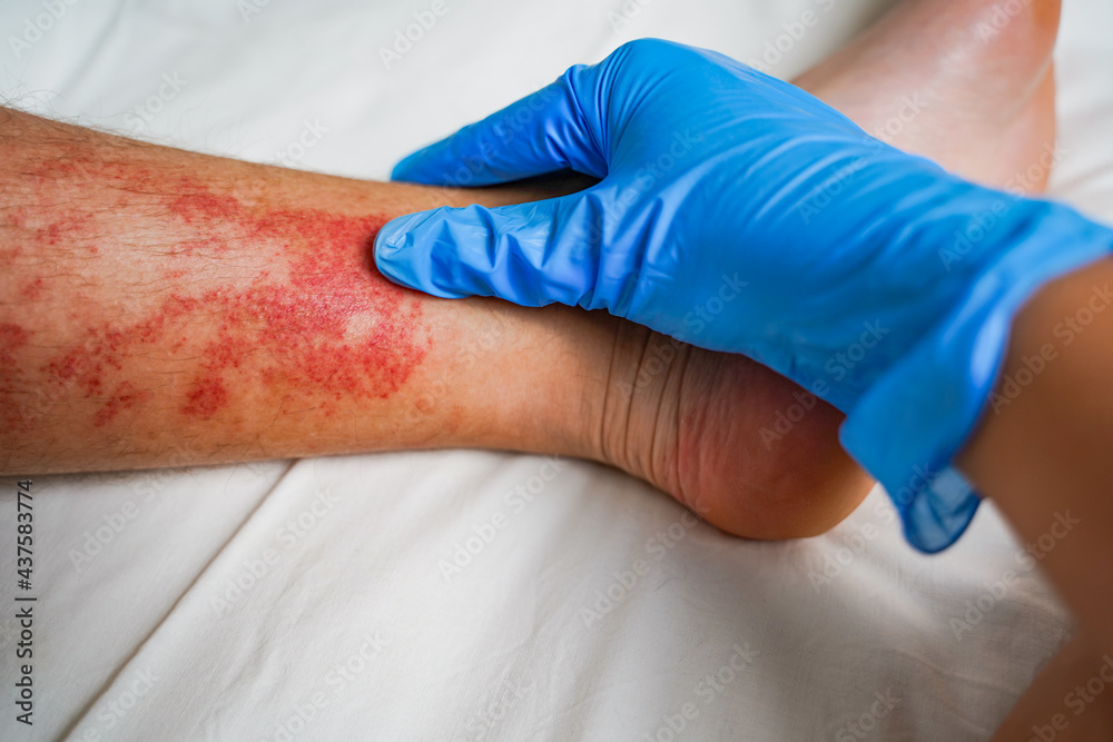 Doctor's hand in a glove examining a patient with skin disease, red irritation, rash and itching on the legs. Eczema, allergies, insect bites