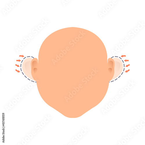 Cosmetic facial plastic ear surgery. Before and after otoplasty surgical correction procedure. Pinnaplasty ear pinning reshaping design template. Faceless portrait. Medical vector illustration.