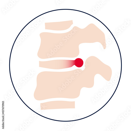 intervertebral hernia concept