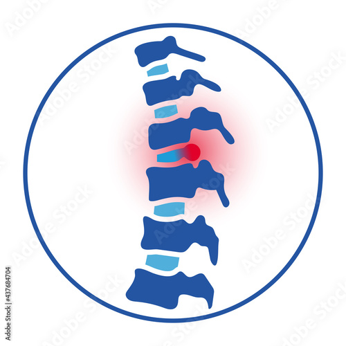 intervertebral hernia concept