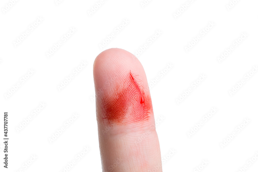 Finger cut, bleeding injured with knife, Flesh blood wound in hand  close-up, Stock Photo, Picture And Low Budget Royalty Free Image. Pic.  ESY-053501703 | agefotostock