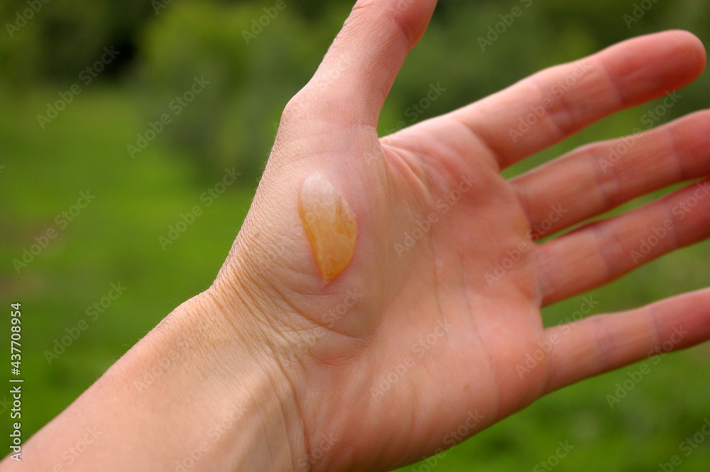 Burning blisters deals