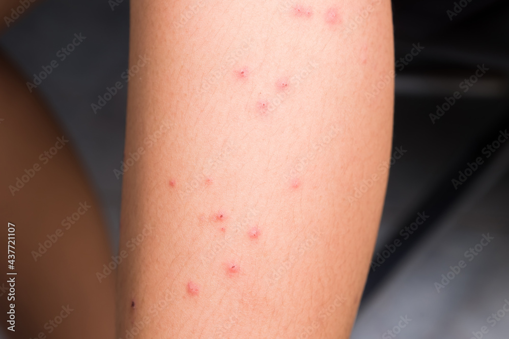 Red allergy pimples on the leg of young girl, caused by mosquitoes bite