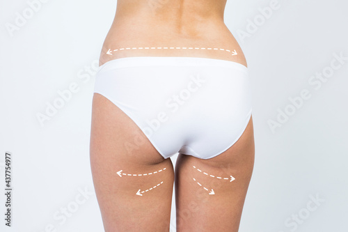 Cellulite removal scheme. White markings on skin legs young woman.
