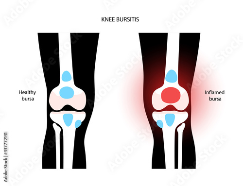Bursitis inflammation concept