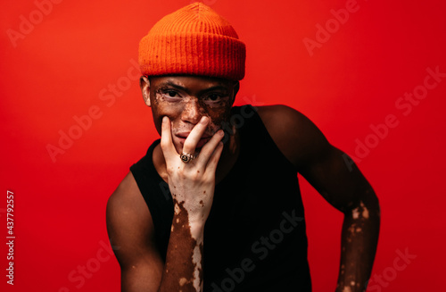 Portrait of a Black man with vitiligo