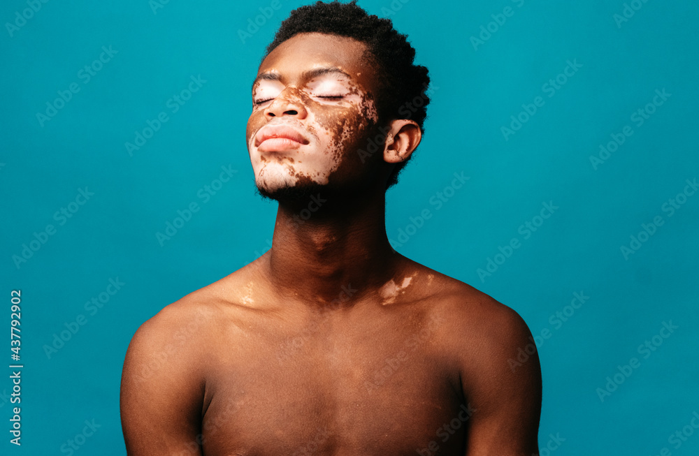 Portrait of a Black man with vitiligo Portrait of a Black man with vitiligo