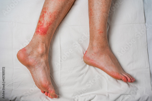 Male leg, itching and red rash caused by insect bites and bites. Health and medical surveillance and concept development.