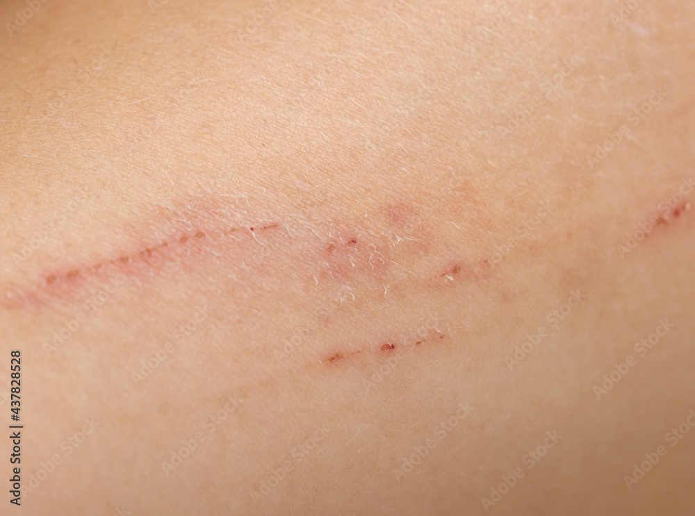 scratches on the skin of the hand as a background scratches on the skin of the hand as a background