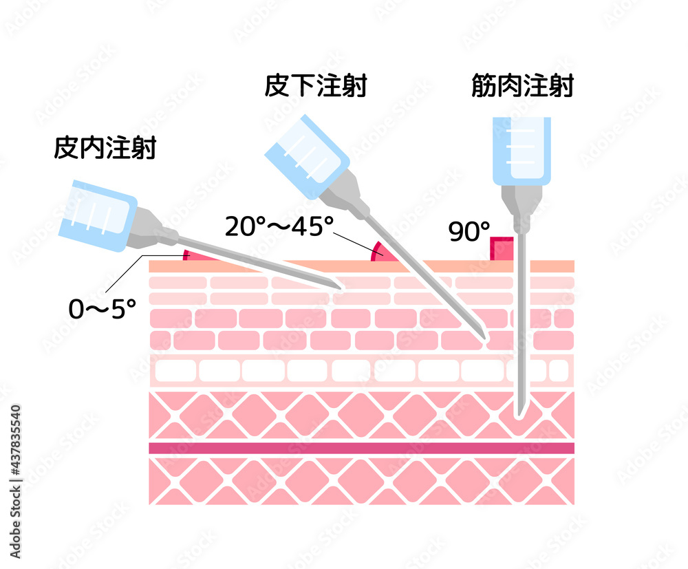 注射の刺入角度の違い ベクターイラスト 筋肉注射 皮下注射 新型コロナワクチン Stock Vector Adobe Stock