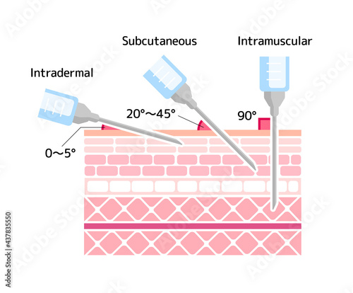 Angles for Inserting Injections vector illustration