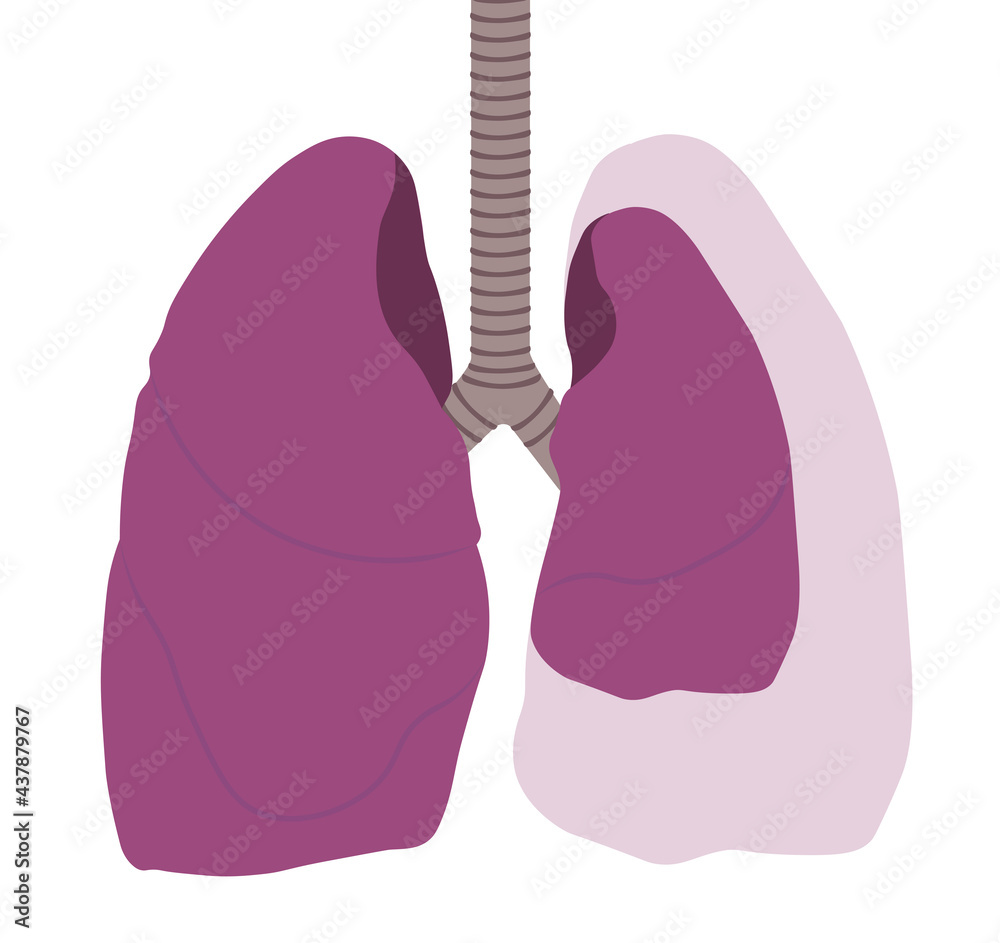 Pneumothorax illustration. Normal lung versus collapsed lung illustration Pneumothorax illustration. Normal lung versus collapsed lung illustration