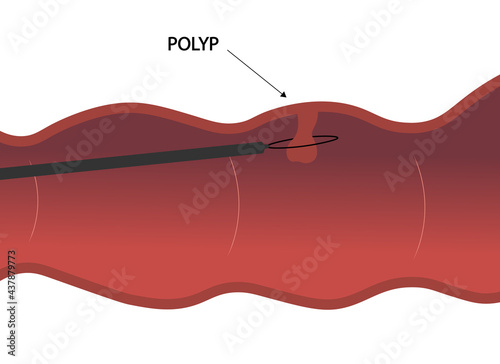 Obraz na plátně Colon polyp. Colon polypectomy illustration.