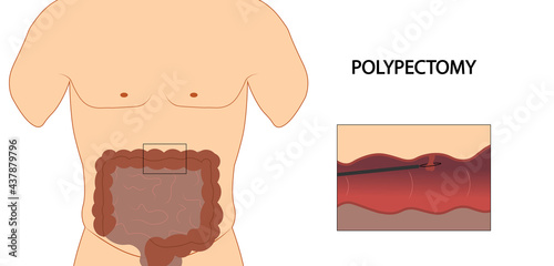 фотографія Colon polyp. Colon polypectomy illustration.