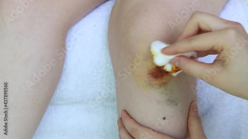 Hand holding cotton wool soaked with Povidone iodine for do basic first to the wound on her girl knee