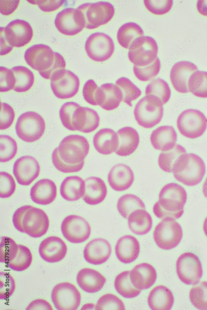 Target cells with abnormal red blood cells in blood smear, specimen from thalassemia patient, analyze by microscope 1000x
Target cells with abnormal red blood cells in blood smear, specimen from thalassemia patient, analyze by microscope 1000x