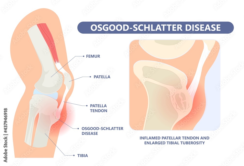 OsgoodSchlatter Disease knee injury Jumper’s Knee arthritis