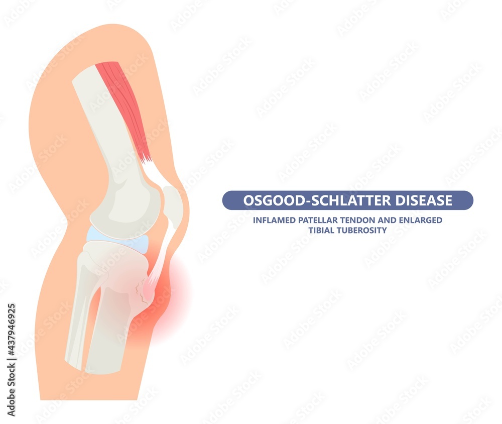 OsgoodSchlatter Disease knee injury Jumper’s Knee arthritis