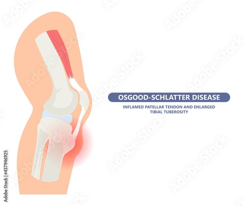 Osgood-Schlatter Disease knee injury Jumper’s Knee arthritis chondromalacia spurt puberty pull athletes joint osteochondritis dissecans injuries photo