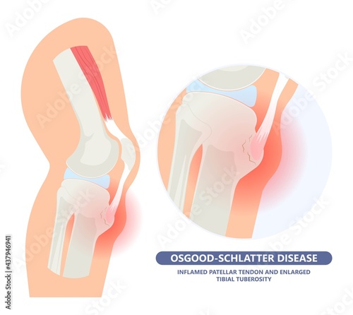 Osgood-Schlatter Disease knee injury Jumper’s Knee arthritis chondromalacia spurt puberty pull athletes joint osteochondritis dissecans injuries photo
