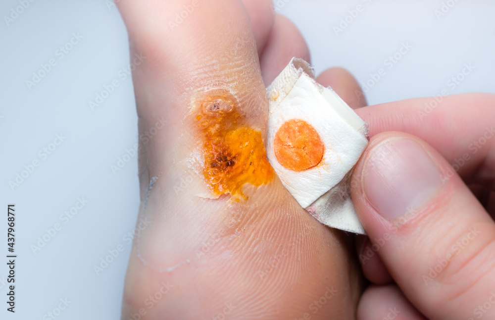 Contagious skin illness on foot. Medical treatment photo..Close up photo of plantar wart on man