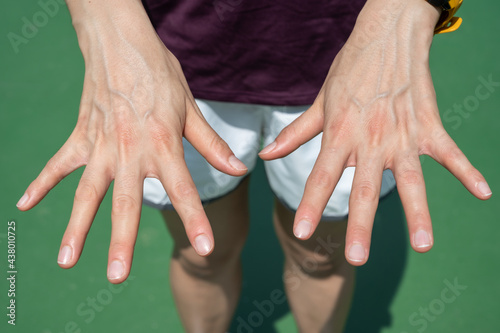 Close up of woman showing her bulging hand veins. Bulging veins can occur due to temporarily rising blood pressure or body temperature when you're exercising or working. photo