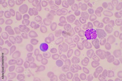 Nucleated Red Blood Cells ( NRC) in blood smear. photo