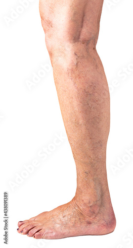 Leg of an elderly Caucasian woman with spider veins and varicose veins on toes isolated on white background. Concept of health care, cosmetic surgery, beauty issue. Outer side of leg, side view.