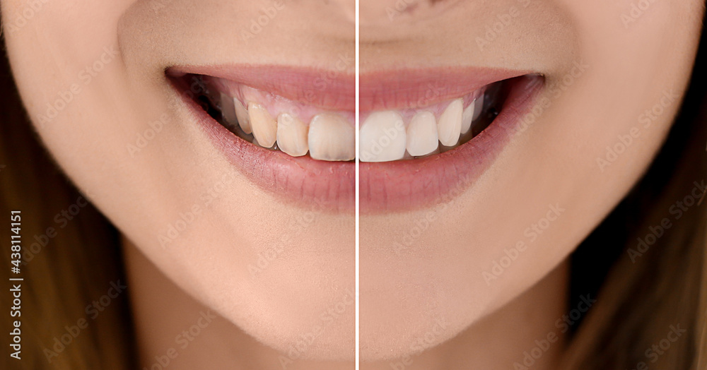 Collage with photos of woman before and after teeth whitening, closeup. Banner design