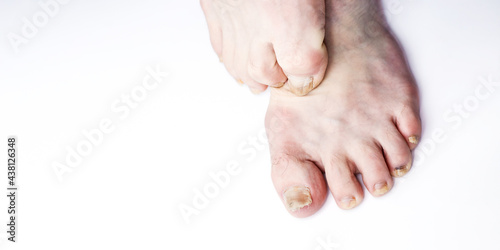 Принти на полотні Nail fungus on legs disease