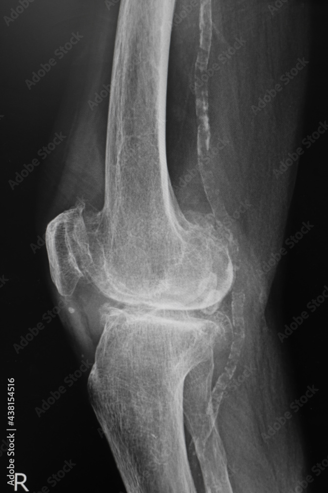 x ray image of knee. Xray of the knee joint, xray shown calcific of vascular. Healthcare and