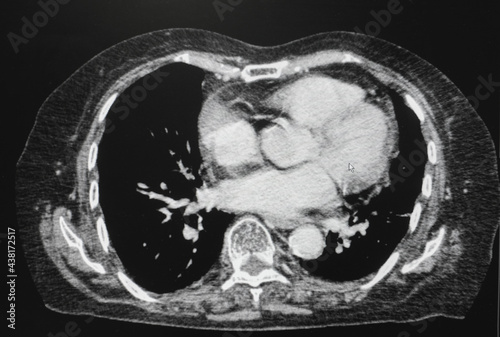 CT Abdomen Cross section View. CT scan (computed tomography) of chest organs. 