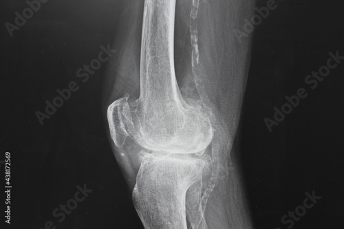 x ray image of knee. X-ray of the knee joint, x-ray shown calcific of vascular. Healthcare and medical concept.