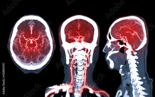 Collection of CTA brain or CT angiography of the brain  comparison Mip technique Axial ,Coronal and Sagittal view for detect brain anueurym.