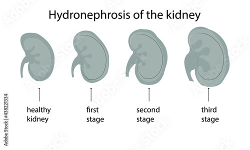 Renal hydronephrosis is a progressive,stages of the disease, persistent expansion of the renal pelvis and calyces, leading to impaired renal function. The disease is associated with impaired urine out