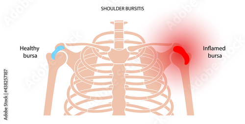 Bursitis inflammation concept