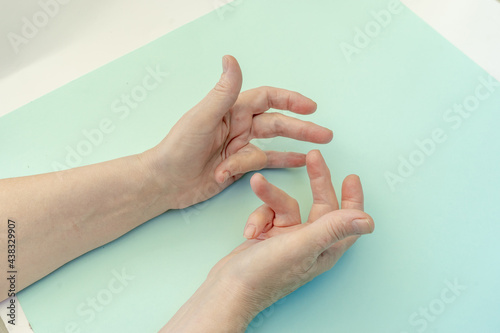 Hands of a woman with twisted fingers. Dupuytren's contracture disease.