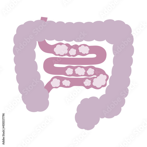 腸内細菌のバランスが崩れてガスが溜まった状態の小腸のイラスト。